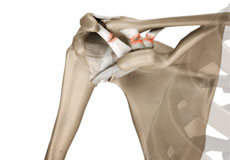 Acromioclavicular (AC) Joint Reconstruction