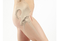 Direct Anterior Hip Replacement