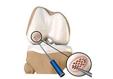 Arthroscopic Debridement