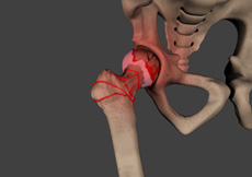Avascular Necrosis