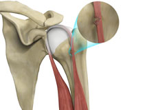 Bicep Tendon Rupture at Shoulder