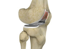 Chondromalacia Patella