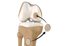 Chondroplasty