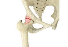 Femoroacetabular Impingement