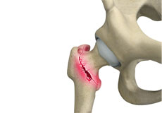 Femur Fracture