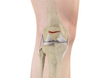 Fractures of the Patella