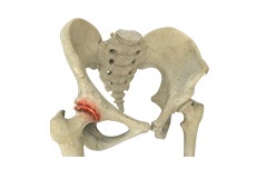 Inflammatory Arthritis of the Hip