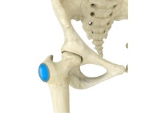 Hip Bursitis