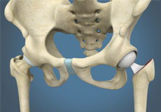 Hip Hemiarthroplasty