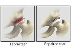 Hip Labral Tear