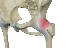 Hip Ligament Injuries