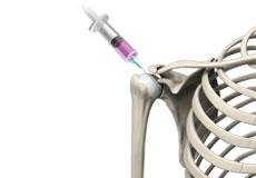 Intraarticular Shoulder Injection