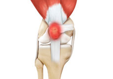 Kneecap Bursitis