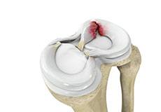 Meniscus Tear Repair