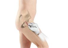 Minimally Invasive Surgery