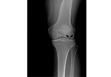 Osteonecrosis of the Knee