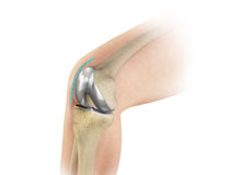 Outpatient Total Knee Replacement