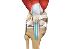 Patellar Tendon Rupture