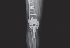 Periprosthetic Knee Fracture Fixation