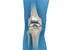 Periprosthetic Knee Fractures