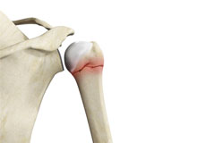 Proximal Humerus Fractures