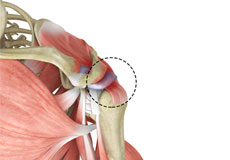 Rotator Cuff Pain