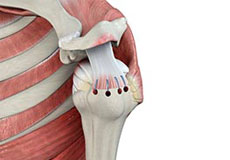 Rotator Cuff Repair