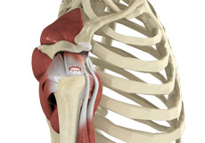 Rotator Cuff Tear