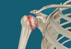 Shoulder Arthritis