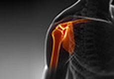 Proximal biceps tendinitis