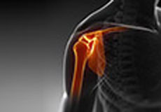 Massive Retracted Rotator Cuff Tear