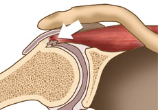 Shoulder Impingement