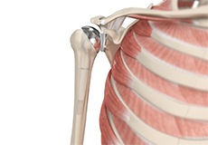 Total Shoulder Replacement