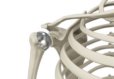 Shoulder Resurfacing