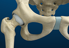 Stress Fracture of hip