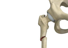 Subtrochanteric hip Fracture