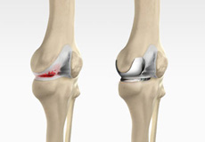 Robotic Unicondylar Knee Replacement