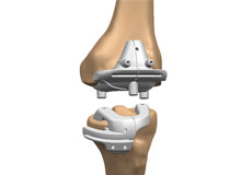 Visionaire Patient-Matched Technology for Total Knee Replacement